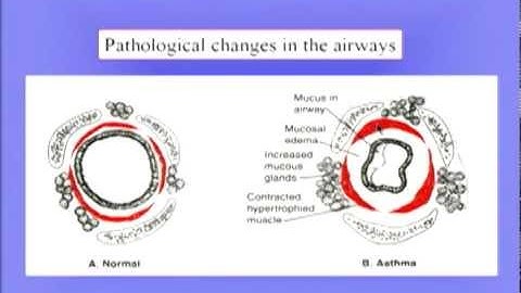 Obstructive Disease II