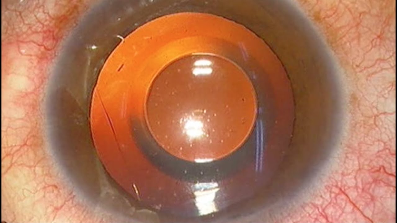 forma sencillo por qué Recambio de lente intraocular de miopía alta (ICL) operada en "El Barco  Ruso" - YouTube