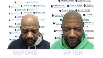 Creative Scalps - Micro Pigmentation Of Owen (Short Version)