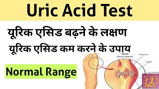 Uric Acid Test In Hindi Uric Acid Treatment Uric Acid Symptoms