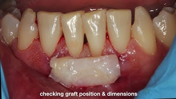 Connective Tissue Graft Tunneling Technique
