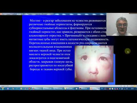 Острый одонтогенный остемиелит челюстных костей у детей