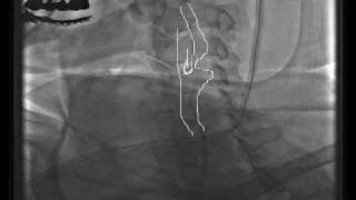 Carotid Stenting.mpg