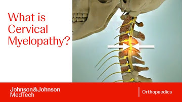 Cervical Myelopathy Explained: Causes, Symptoms & Treatments | DePuy Synthes