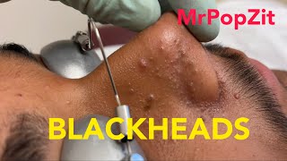 Tons of blackheads. 17 minutes of extractions.Blackheads, whiteheads,milia. Face and ears. MrPopZit