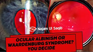 Ocular Albinism OR Waardenburg Syndrome? You Decide