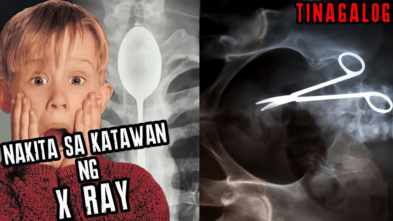 BAGAY NA NAKITA NG X RAY SA KATAWAN NG TAO YouTube