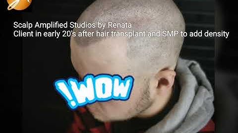 Scalp Micropigmentation (SMP) after Hair Transplant (FUE)