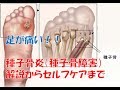 【足が痛い！】種子骨炎とは　手術をする前にこの動画をみて下さい。
