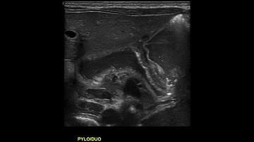 Dilated stomach and proximal duodenum
