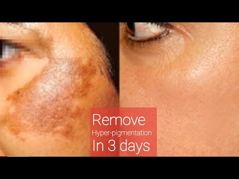 How to get rid of hyper-pigmentation, freckles,dark spots-circles,melasma in 3 days - YouTube