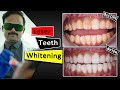 Teeth whitening with laser  fastest  safest way