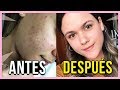 5 JABONES PARA ELIMINAR EL ACNÉ EN UNA NOCHE | Priscila