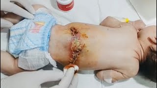 Newborn Mms Baby Healing Process Safe Post Surgery Care Routine