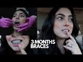 3 MONTHS BRACES UPDATE (I REGRET THIS...)