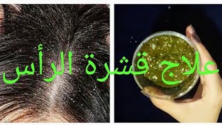 علاج قشرة الشعر وحكة فروة الرأس من اول استعمال وبمكونات طبيعية وصفة فعال