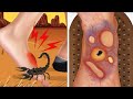 Asmr causes and the best treatment feet contain scorpion venom     2023
