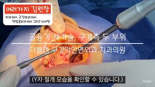 구개측 골융기 제거술 실황입니다.