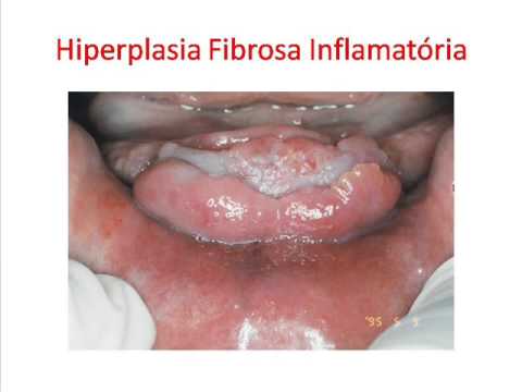 Vídeo: Hiperplasia Tireoidiana, Hiperplasia Difusa E Nodular