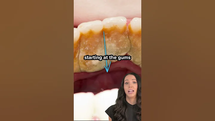 plaque vs tartar on teeth (dental calculus) #shorts