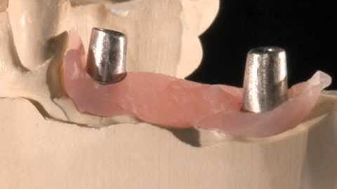 Implants Implant Bridge Procedure