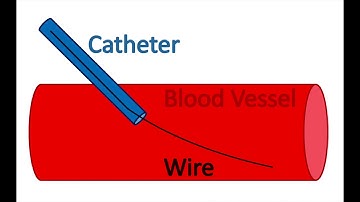 What is a Tace Procedure?