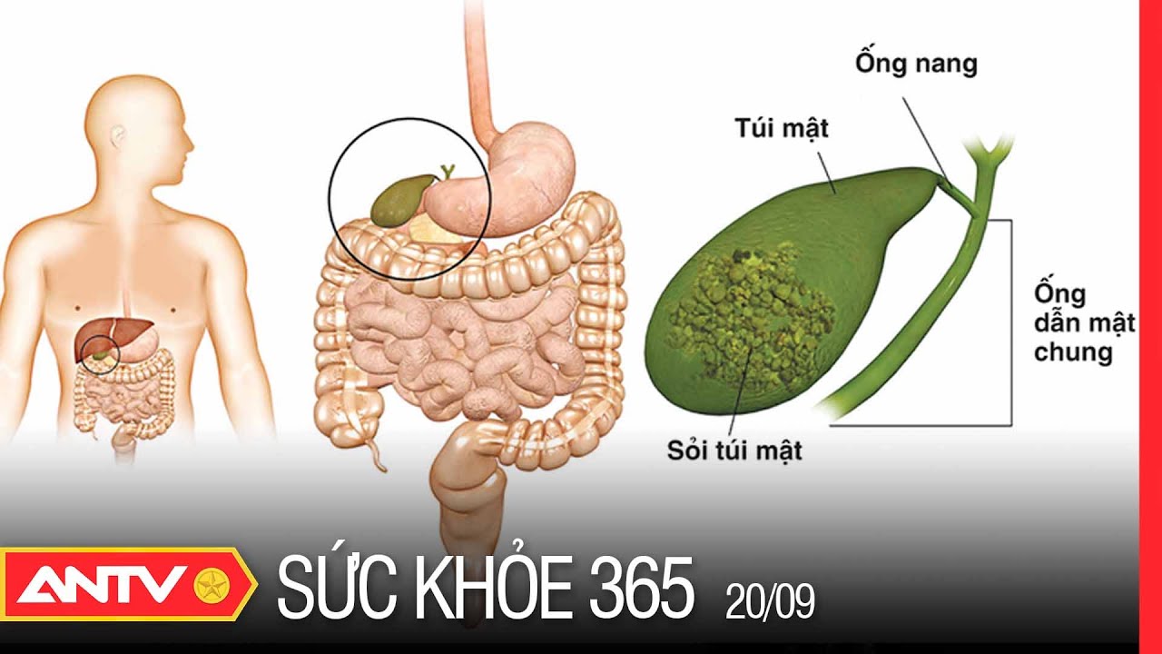 Sỏi Mật - Nguyên Nhân, Triệu Chứng Và Cách Điều Trị |... - youtube