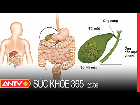 Video Sỏi Mật - Nguyên Nhân, Triệu Chứng Và Cách Điều Trị |... - youtube