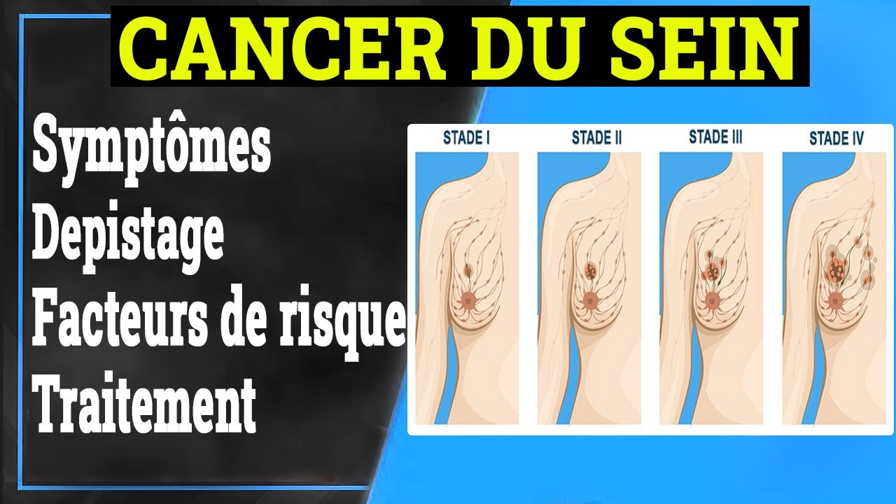 Cancer du Sein: Symptômes, Causes, Traitement | Gynécologie
