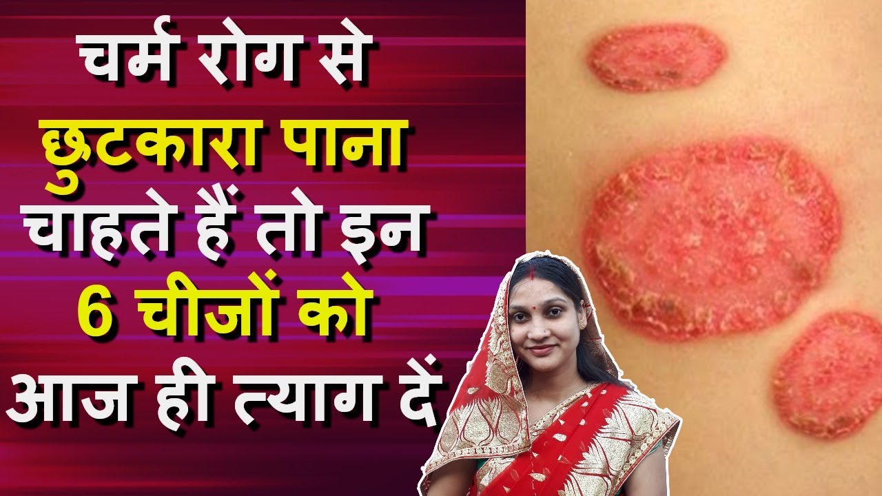 चर्म रोग से छुटकारा पाना चाहते हैं तो इन 6 चीजों को आज ही त्याग दें