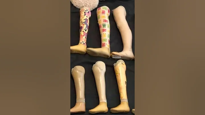 The Shriners Children’s Hospital is one of the largest providers of prosthetics across the country.