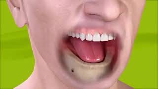 Dantų Atstatymas Naudojant 2 Implantus
