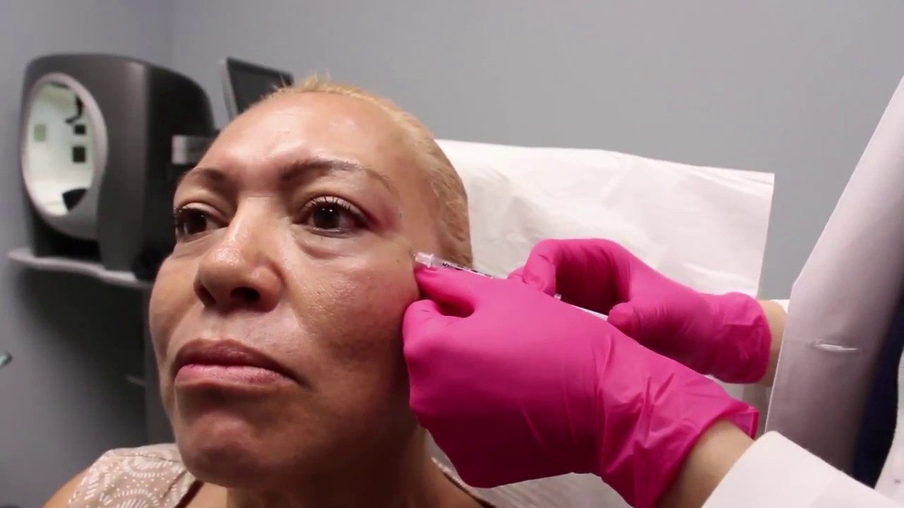 Banner for Botox for the Glabella, Crows Feet, and Forehead