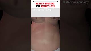 Gastric Banding for Weight Loss | How to lose weight fast | Weight loss | Weight loss surgery