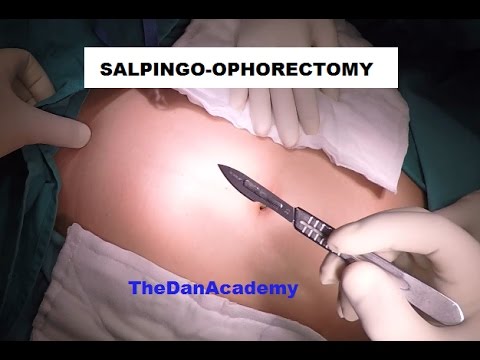 Ooforectomia por video / Video Oophorectomy 