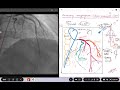 Coronary Angiogram. RAO cranial view.