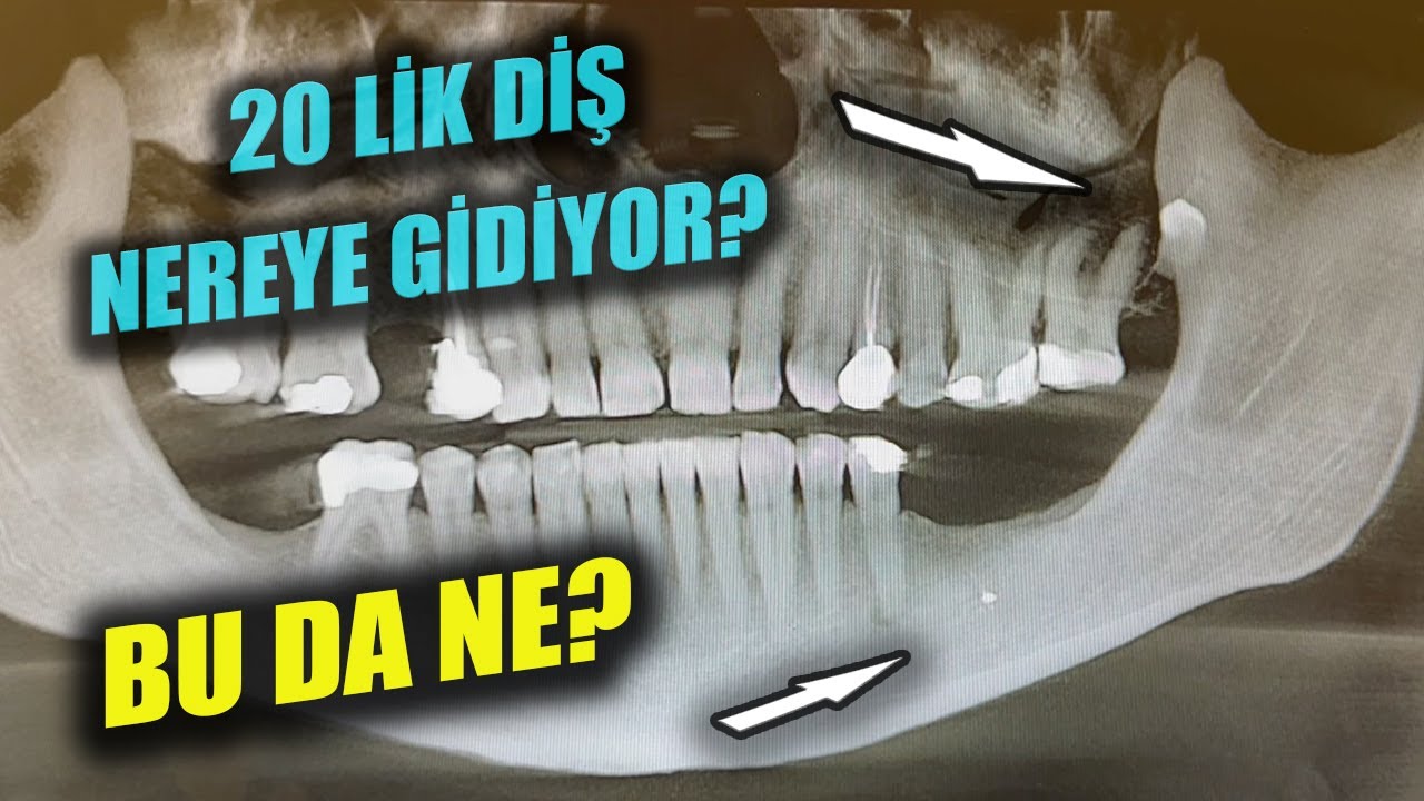 Tomografi ve Panoramik Arasındaki Fark? Dişte Apse Varmı? Kanal Tedavisi Gerekli mi? Yirmi Yaş Dişi