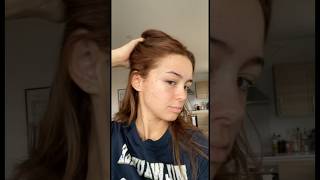 MY EXPERIENCE WITH GUTTATE PSORIASIS #shorts