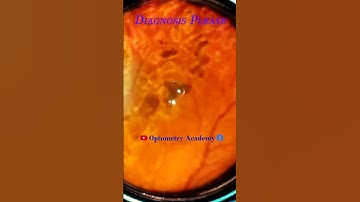 Smartphone Fundus Videography | Fundus Photography | Retinal Pathology | Short Video 50
