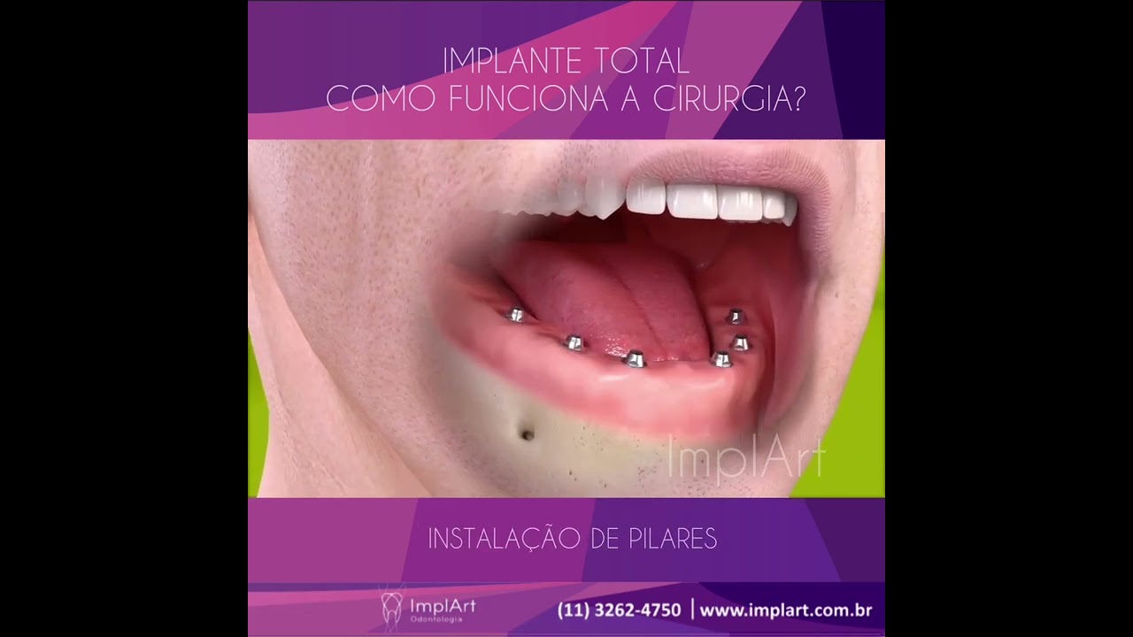 IMPLANTE TOTAL: CONHEÇA AS ETAPAS DE TRATAMENTO