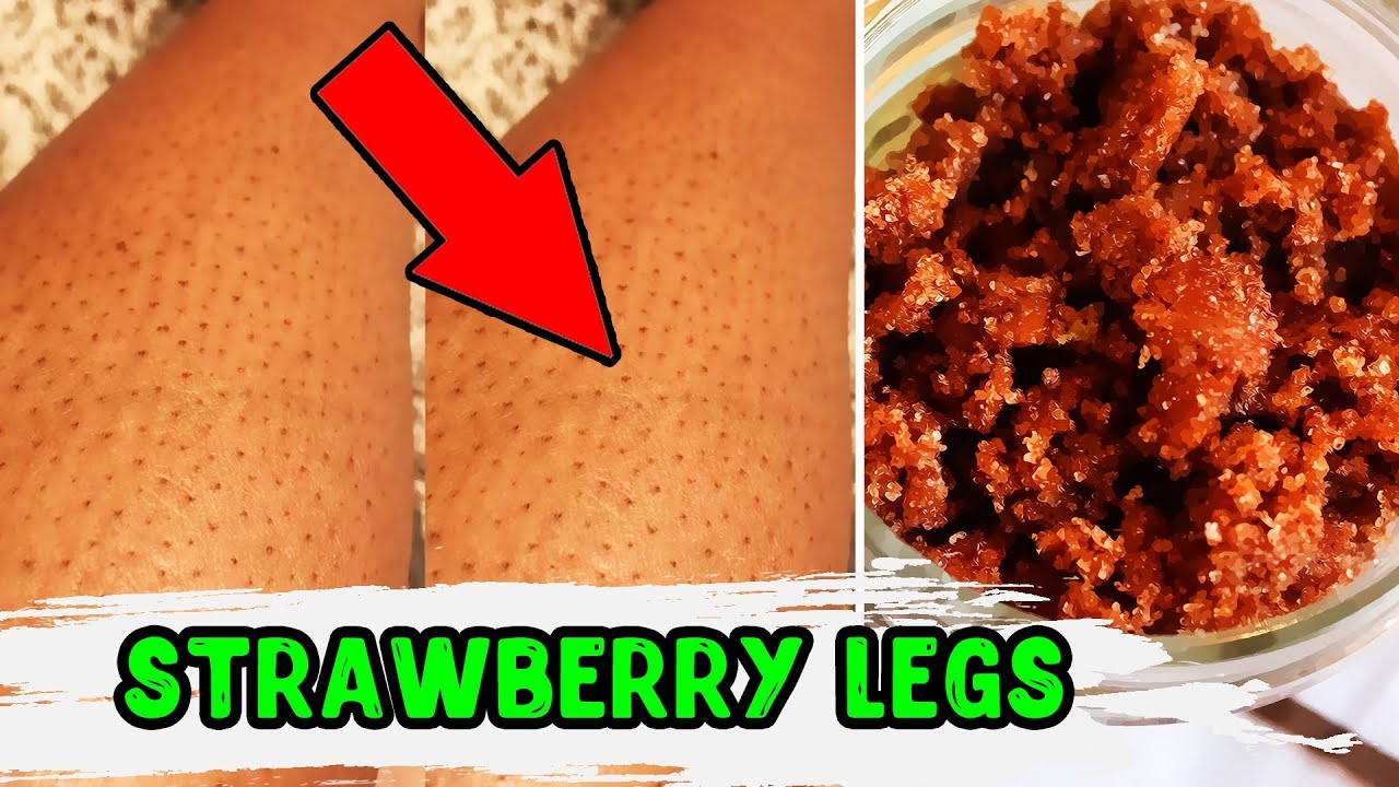 How To Get Rid Of Strawberry Legs – 3 Simple Steps To Smooth Skin - YouTube