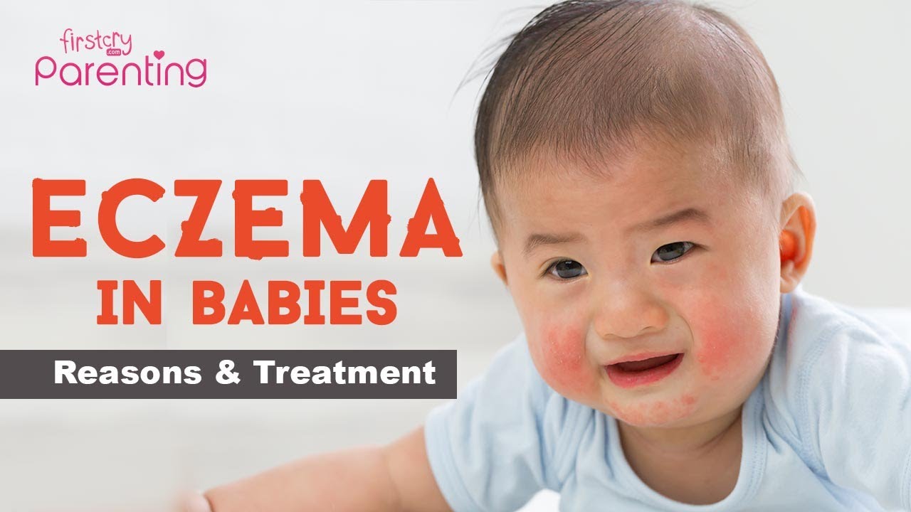Baby Eczema Causes Signs And Treatment Youtube