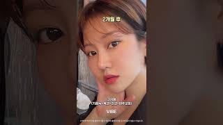 코성형 + 기증늑 + 복코교정 + 긴코교정 + 비주교정 #shorts