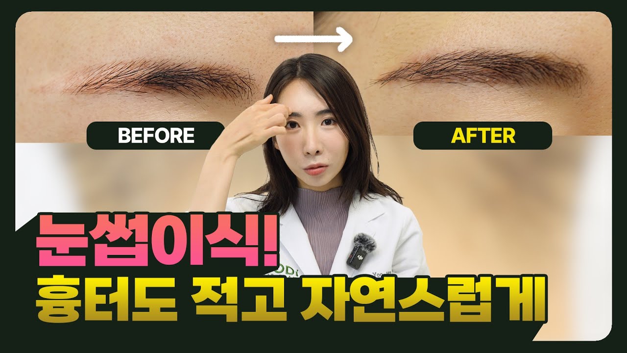 눈썹이식, 모디는 이렇게 진행합니다