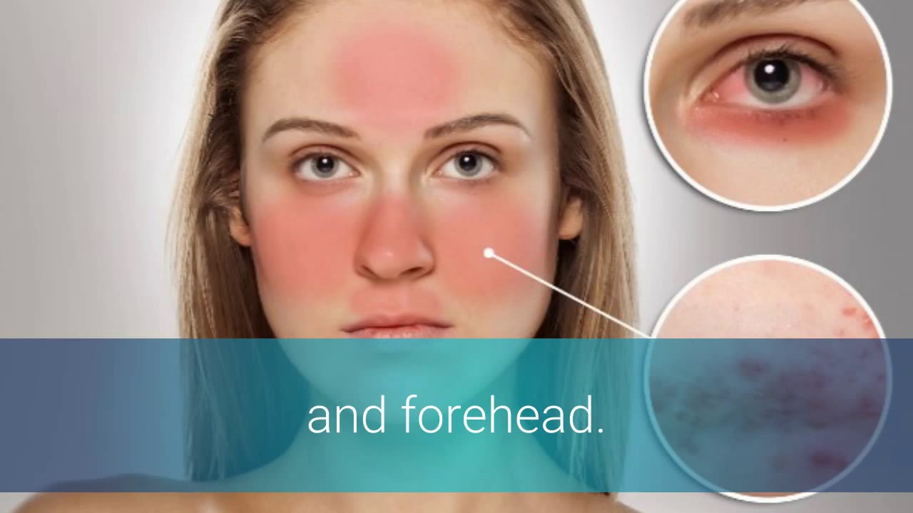 Communication on this topic: Still Battling Acne It Could BeRosacea, still-battling-acne-it-could-berosacea/ Forum on this topic: Still Battling Acne It Could BeRosacea, still-battling-acne-it-could-berosacea/