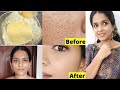 முகத்தில் உள்ள பள்ளம், குழிகள் நீங்க||How to get rid of Large Open &amp; Clogged Pores Natural Remedy