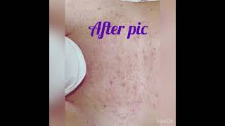 Male Brazilian wax with ingrown hair