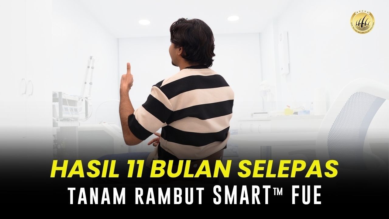 11 Months Post-SMART™ FUE Hair Transplant Results | GLOJAS Specialist Clinic