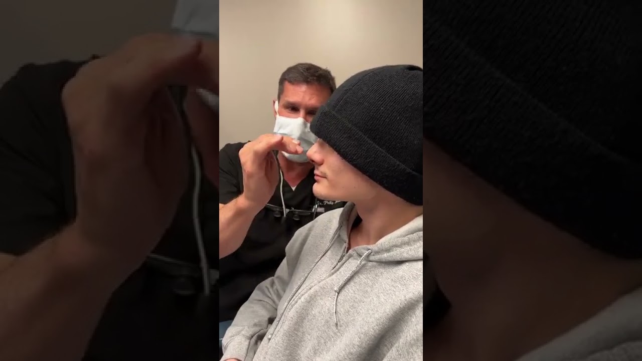 Male Nose Job in New York Results Revealed