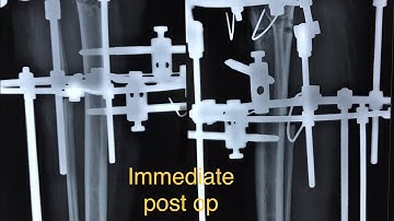 High Tibial smile osteotomy by ilizarov method